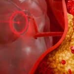 5 Silent Signs of High Cholesterol You Shouldn’t Ignore