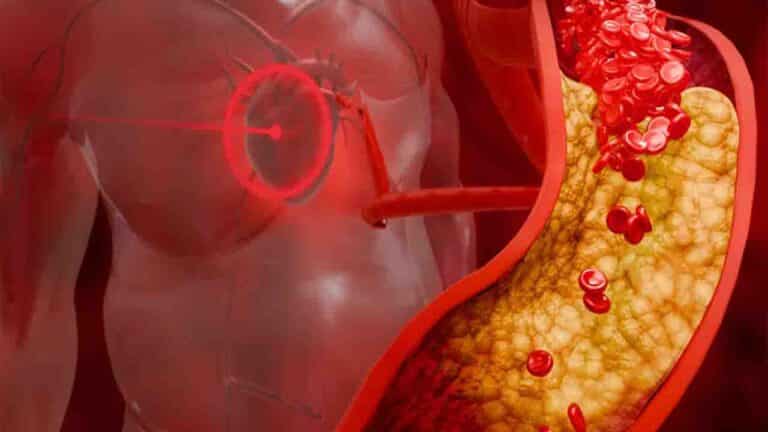 High Cholesterol Symptoms: How to Spot the 'Silent Killer' Early