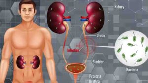 Why UTI in Men is Rare but Far More Dangerous Than in Women